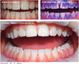 Guided BioFilm Therapy